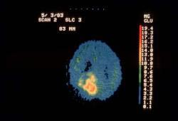 brain-tumor.jpg