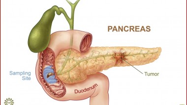 Early Detection of Pancreatic Cancer Using Light