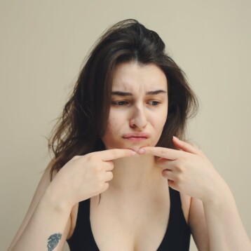 How To Treat Menstrual Acne Flare-Ups