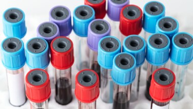 Disease PBMCs and Their Applications in Research
