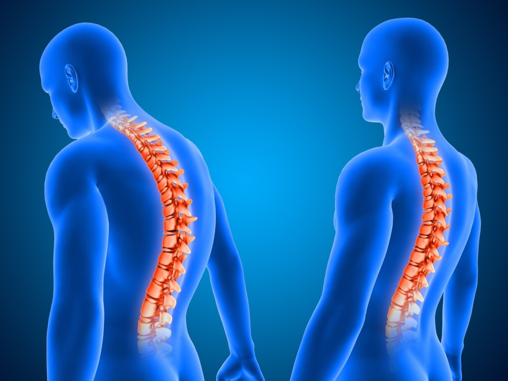 Spinal Cord Stimulator